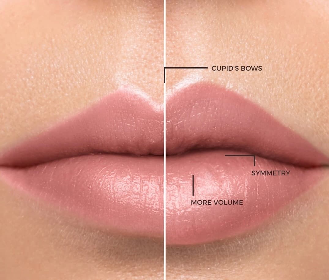 Natural-looking lip filler results at Beauty Icon Solihull