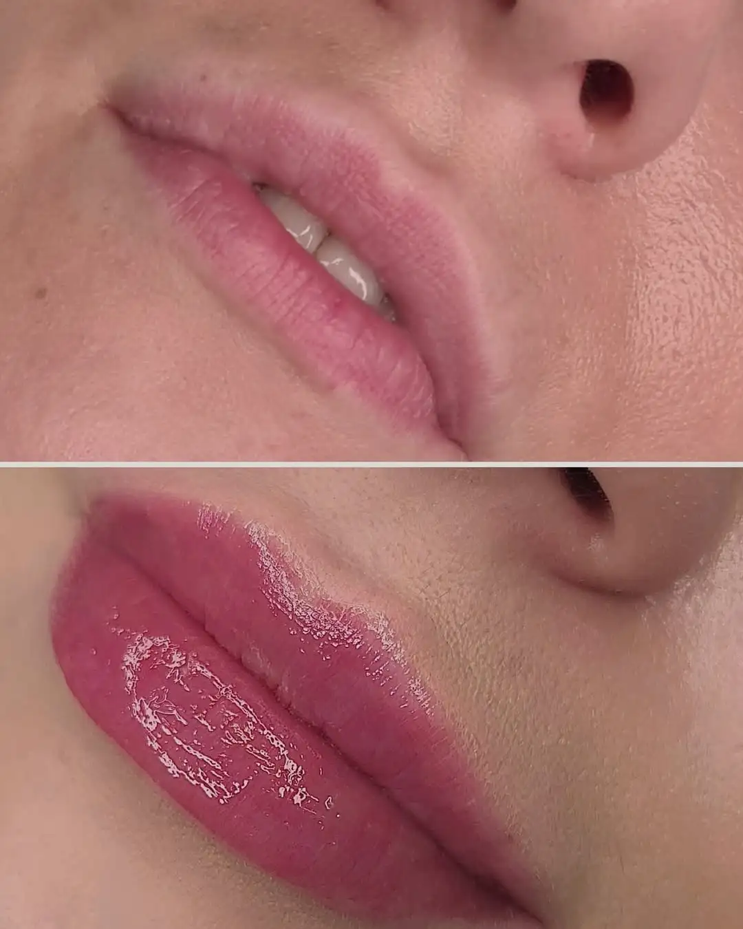 Lip Rejuvenation