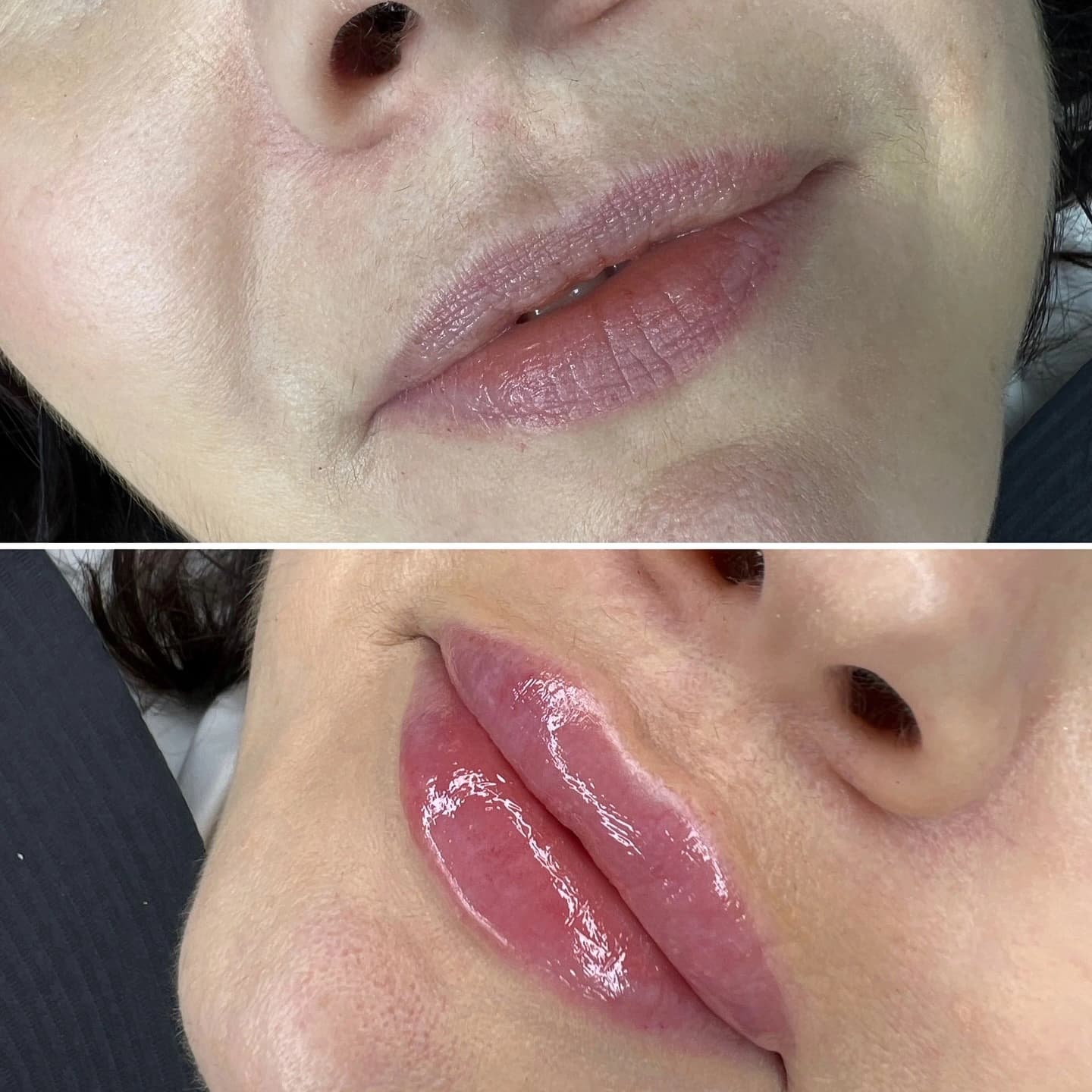 Natural lip enhancement before and after at Beauty Icon Solihull