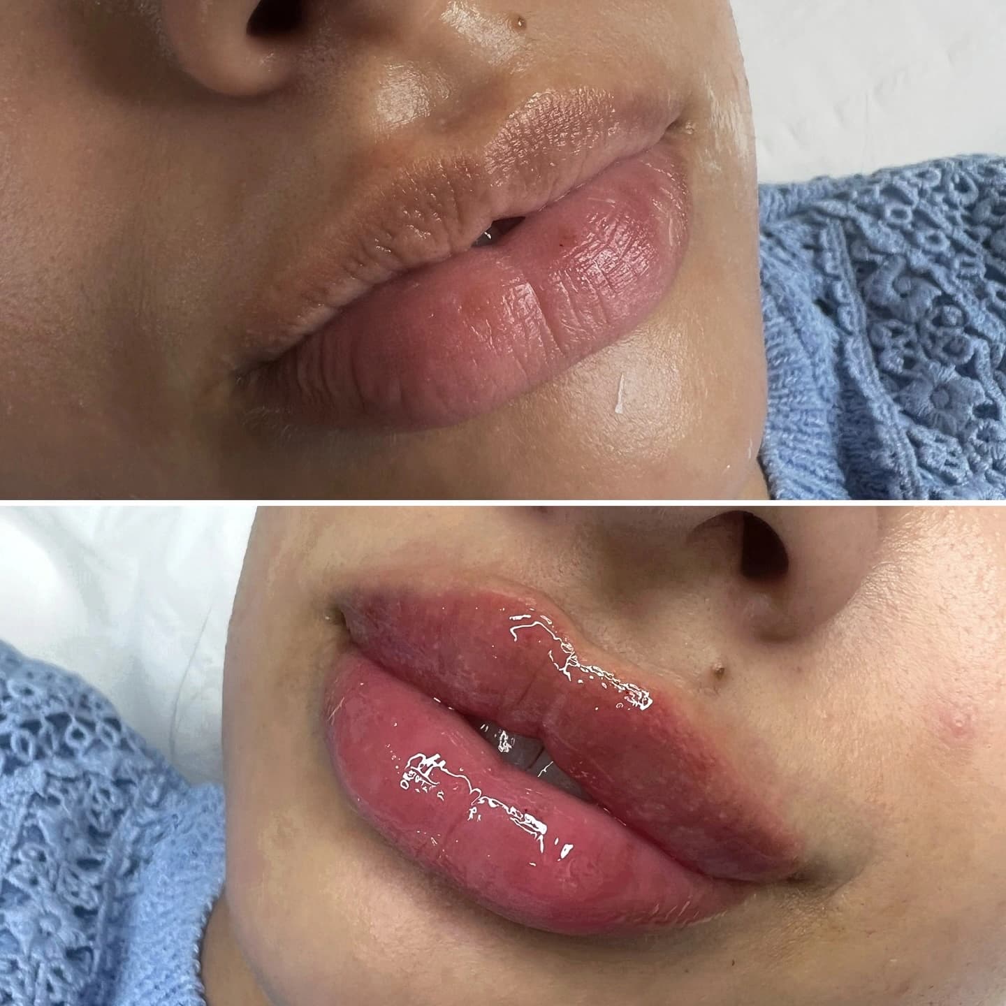 Lip filler before and after - client work at Beauty Icon Solihull