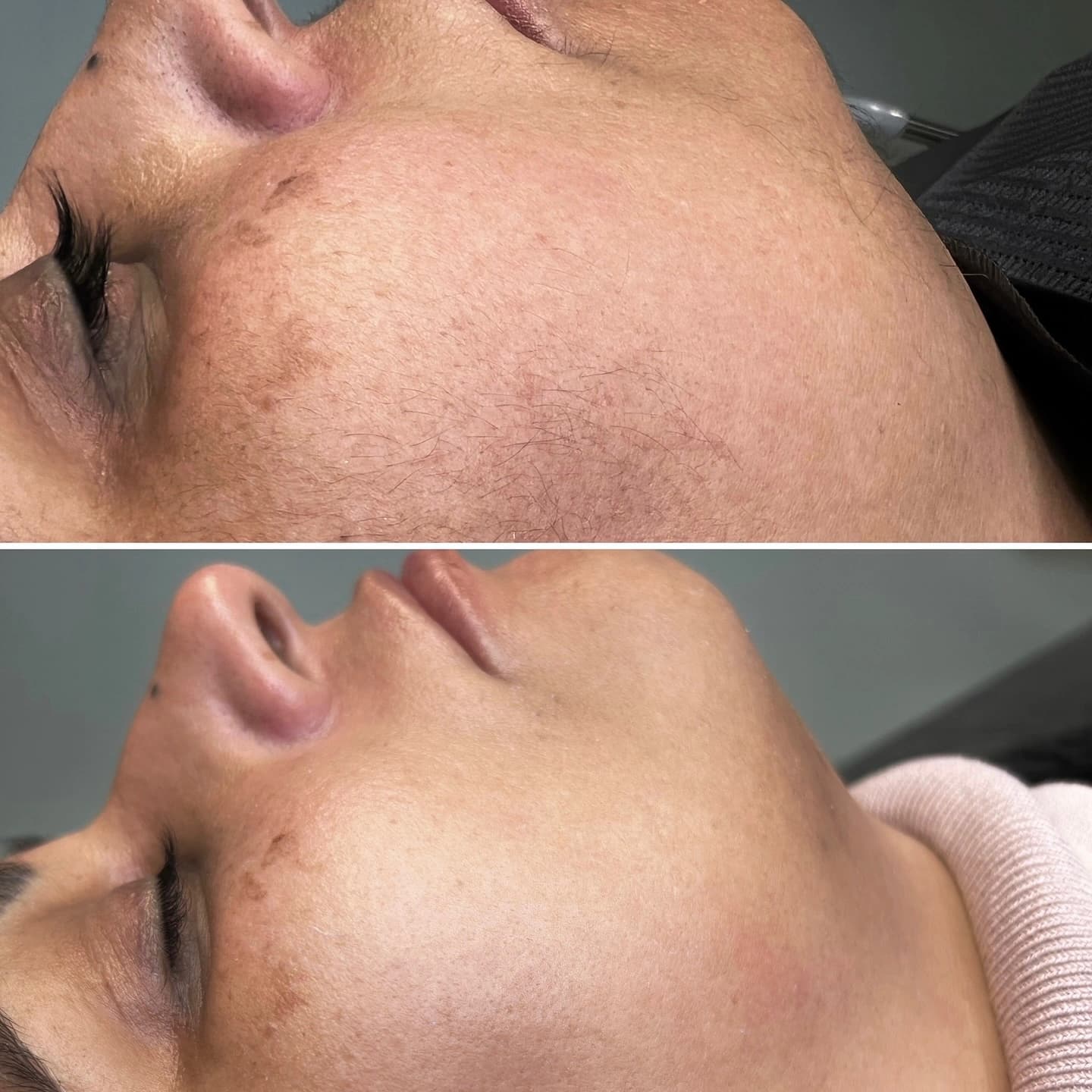 Micro-needling