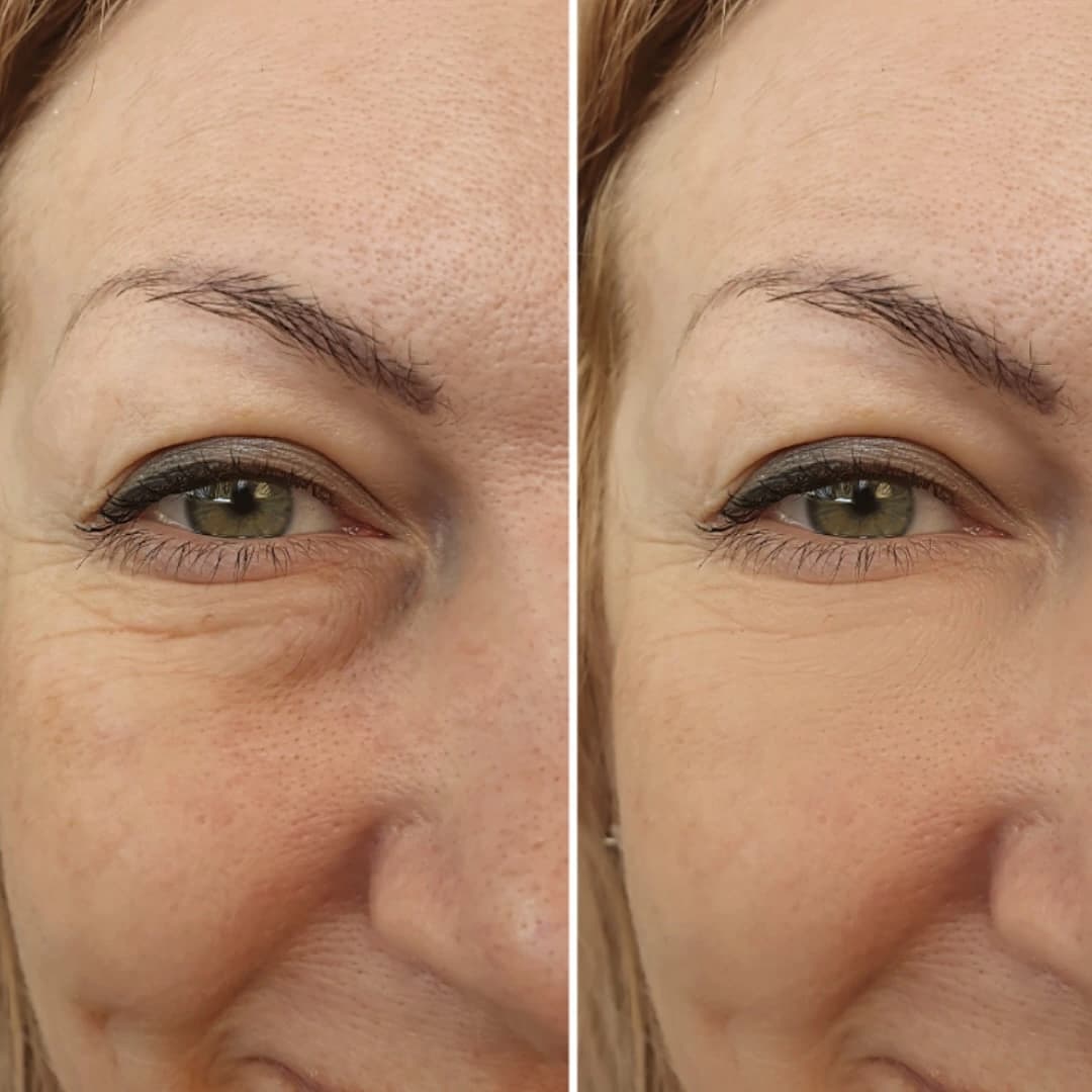 Eye Treatments