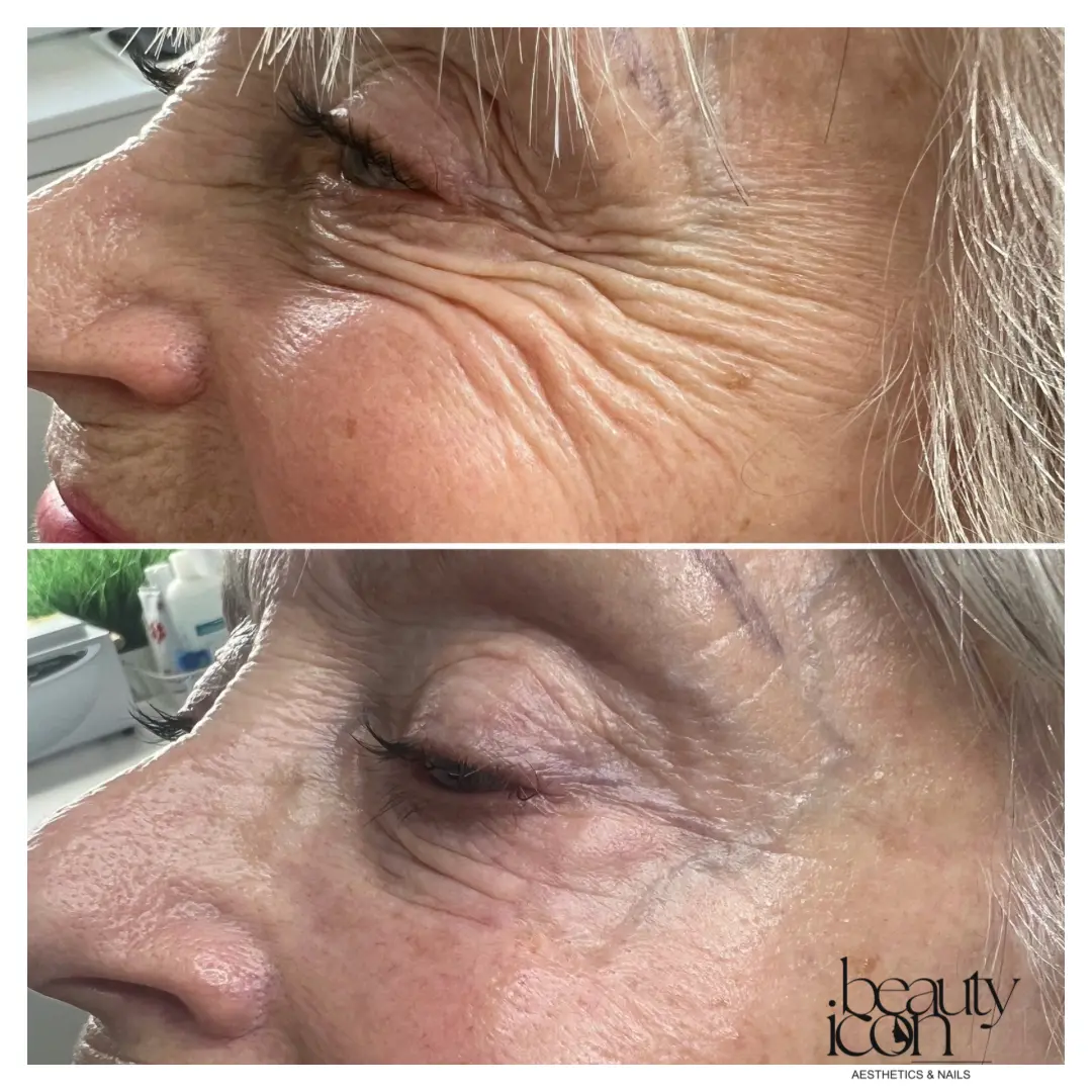 Anti-wrinkle - crow's feet - client work at Beauty Icon Solihull