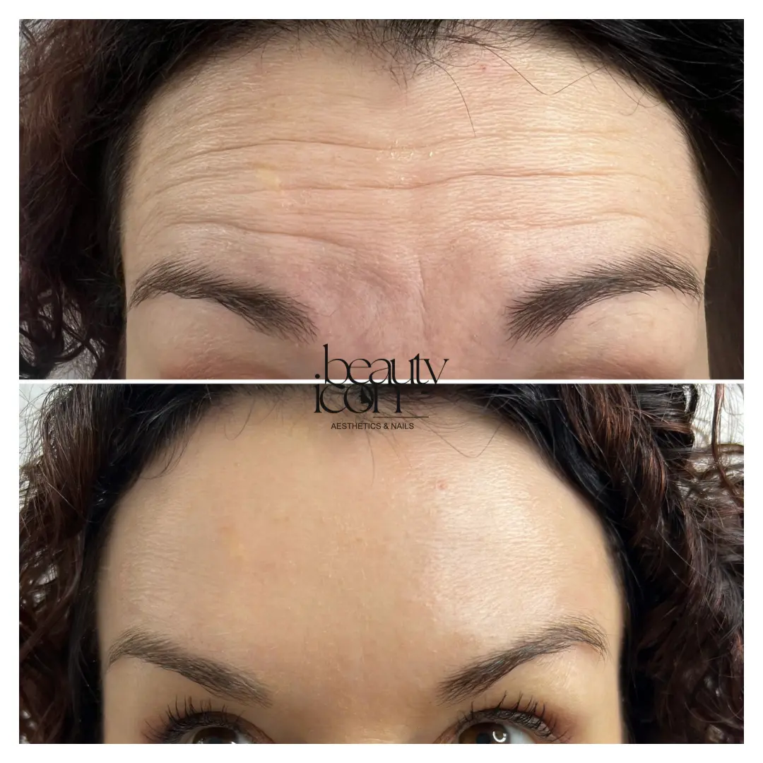 Anti-wrinkle - forehead - client work at Beauty Icon Solihull
