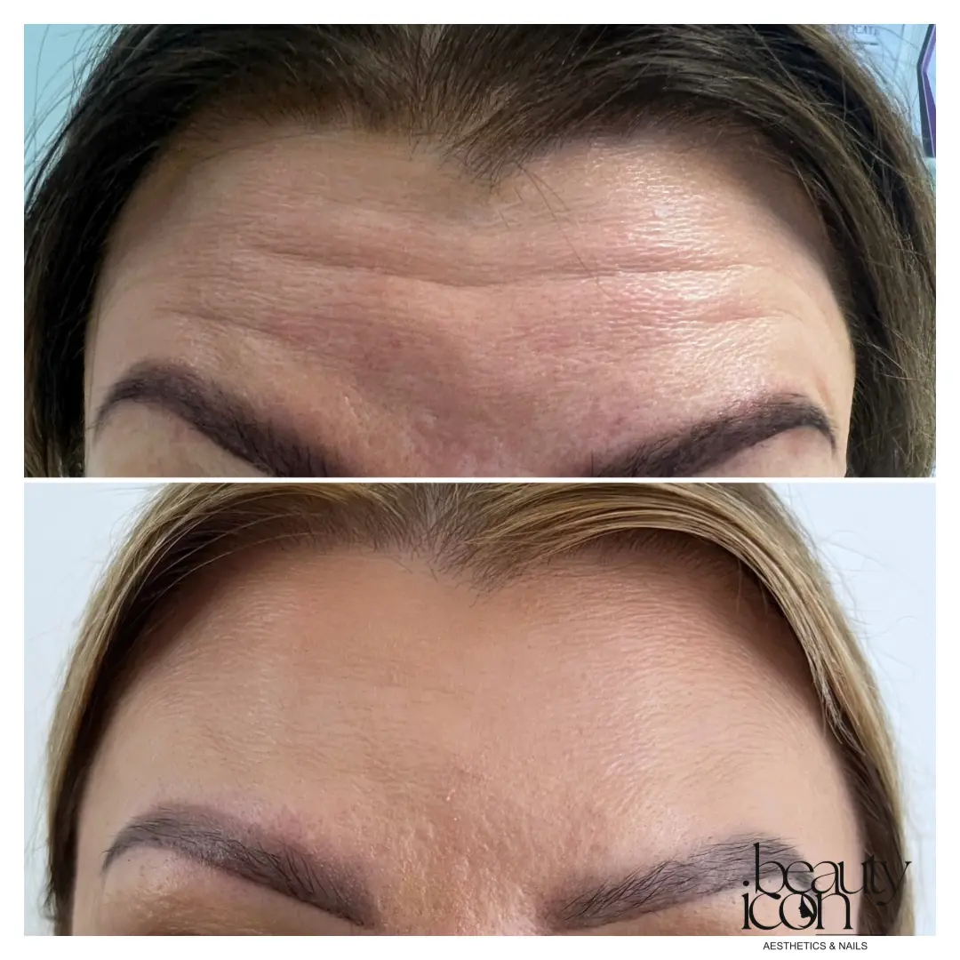 Anti-wrinkle - forehead - client work at Beauty Icon Solihull
