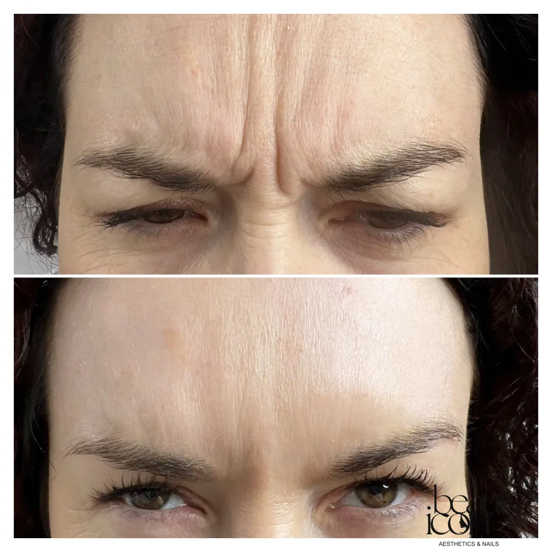 Anti-wrinkle - frown lines - client work at Beauty Icon Solihull