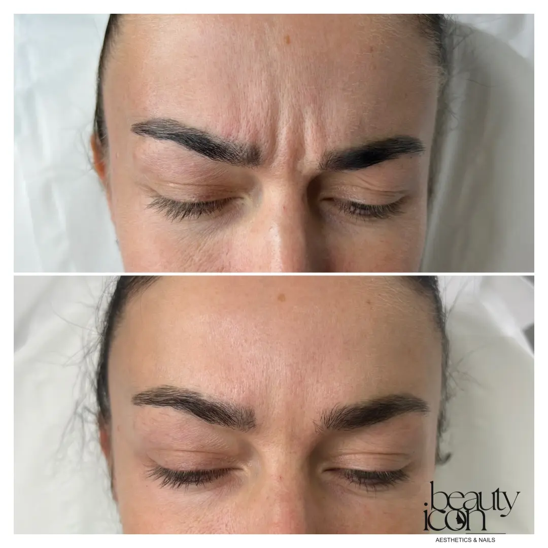 Anti-wrinkle - frown lines - client work at Beauty Icon Solihull
