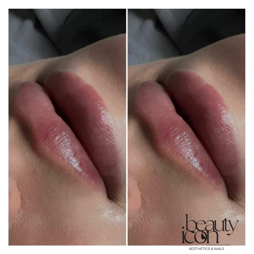 Lip fillers - client work at Beauty Icon Solihull