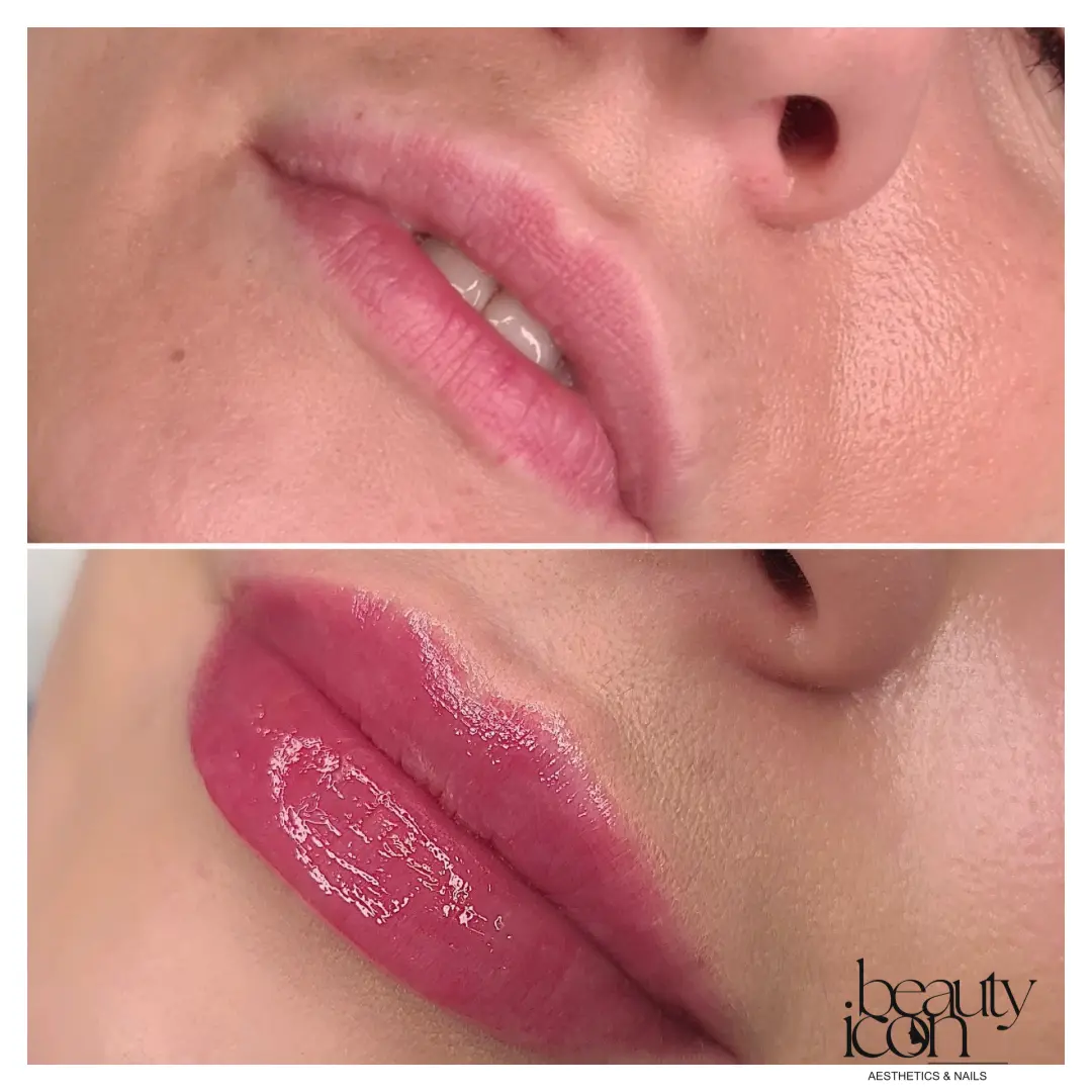 Lip fillers - client work at Beauty Icon Solihull
