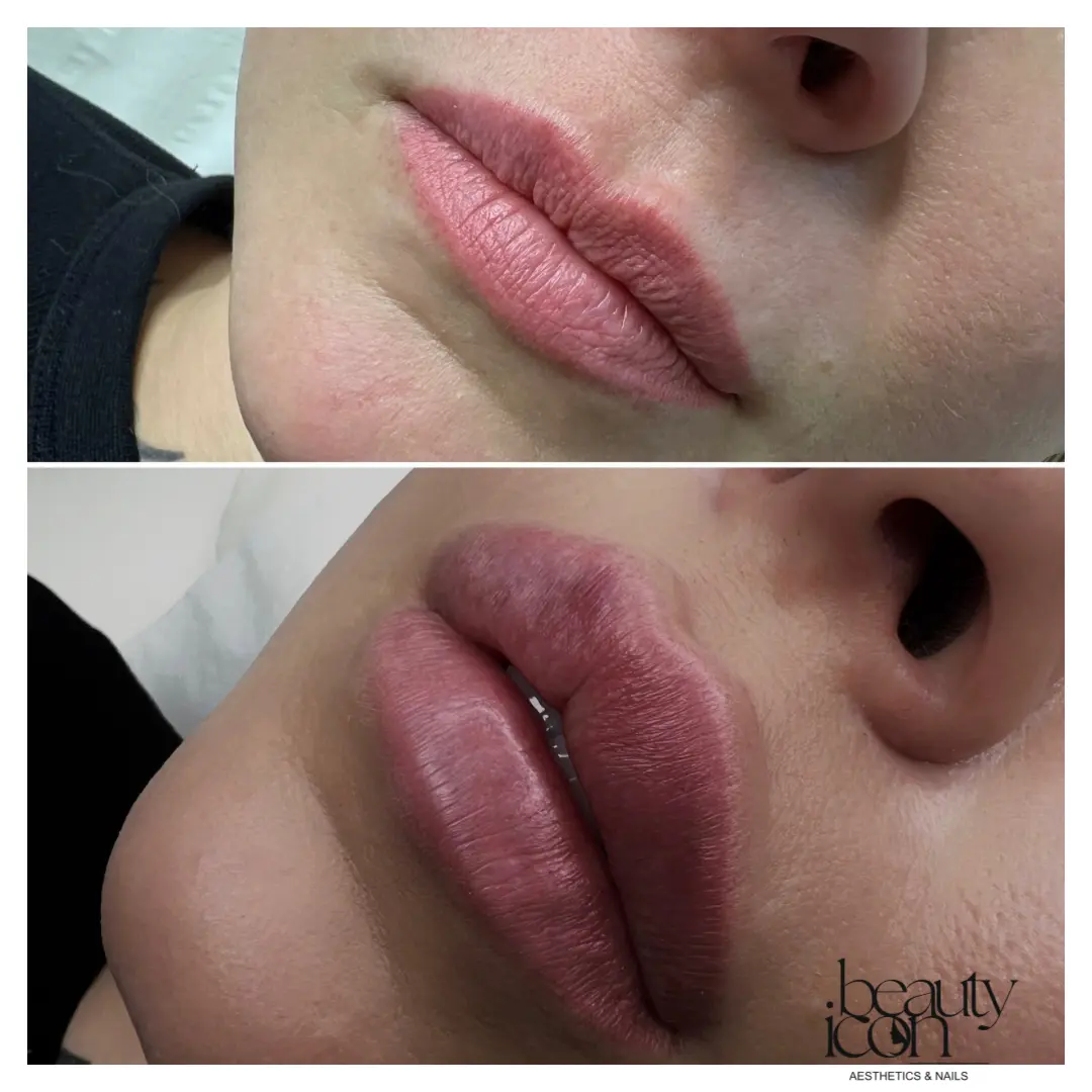 Lip fillers - client work at Beauty Icon Solihull