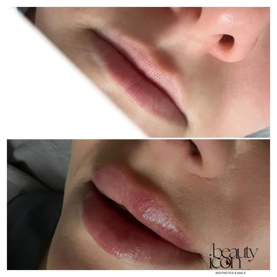 Lip fillers - client work at Beauty Icon Solihull