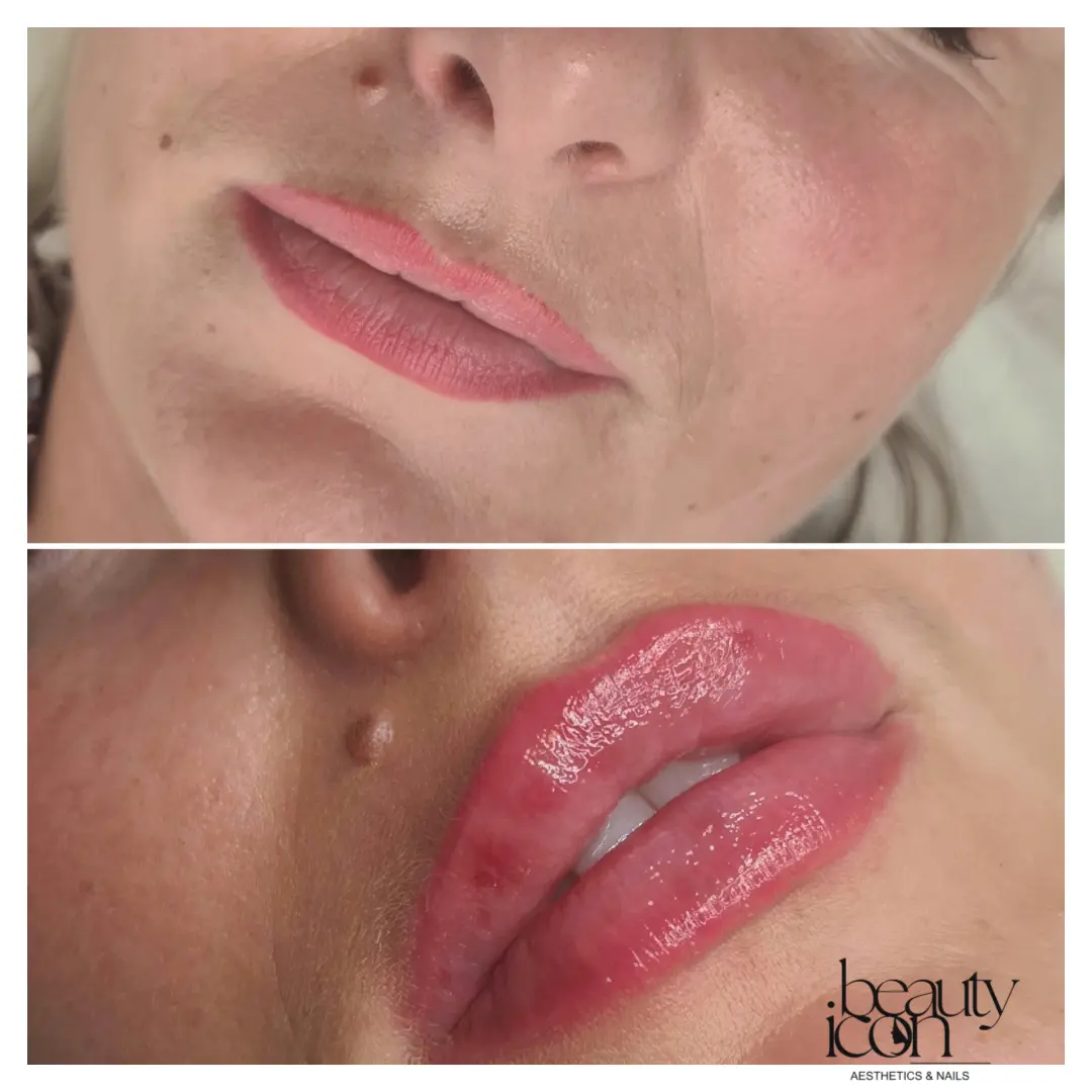 Lip fillers - client work at Beauty Icon Solihull