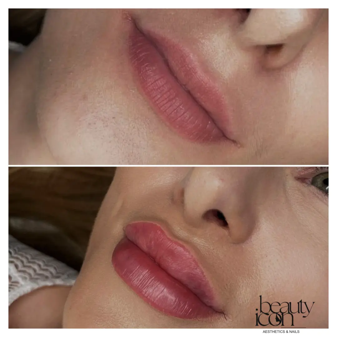 Lip fillers - client work at Beauty Icon Solihull