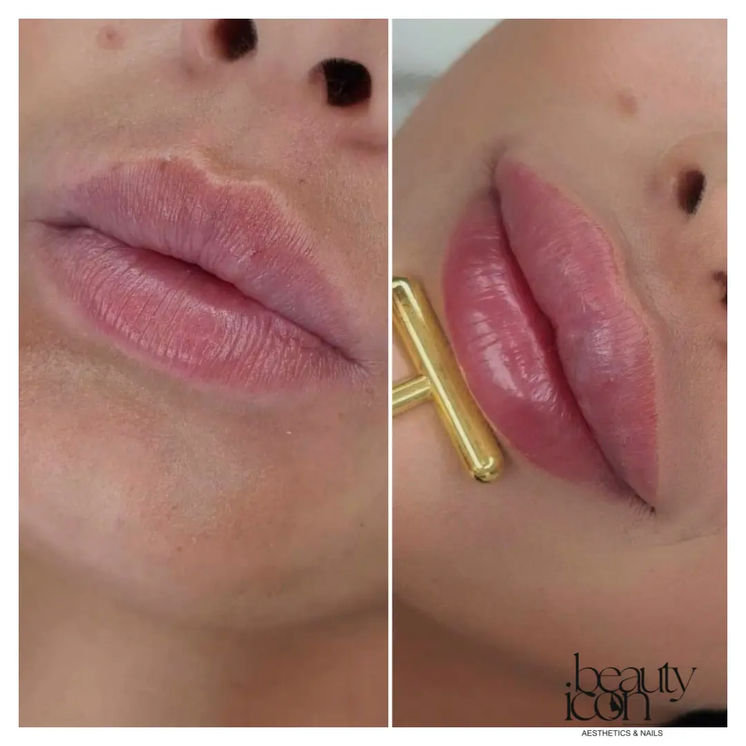 Lip fillers - client work at Beauty Icon Solihull