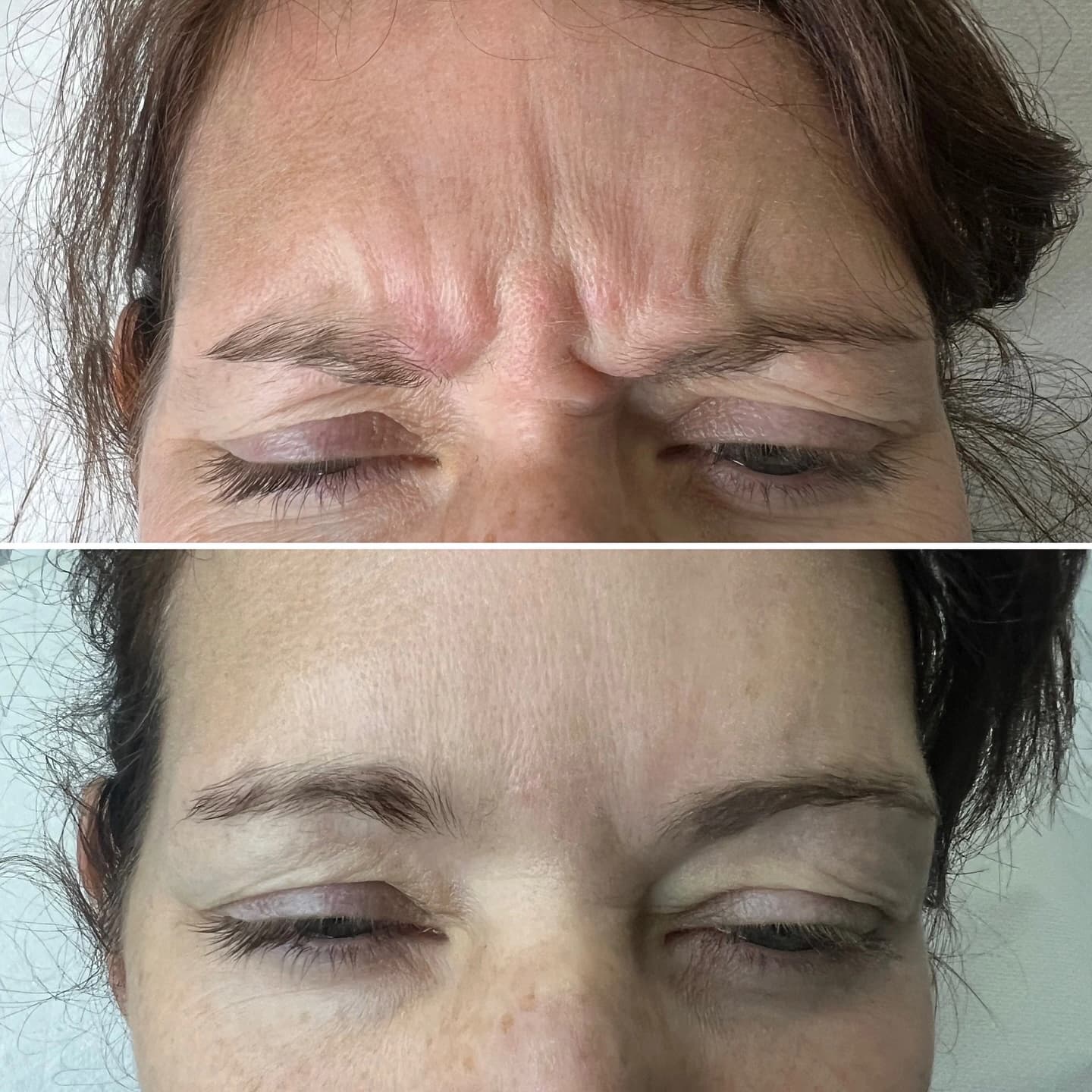 Frown lines before and after anti-wrinkle treatment at Beauty Icon Solihull