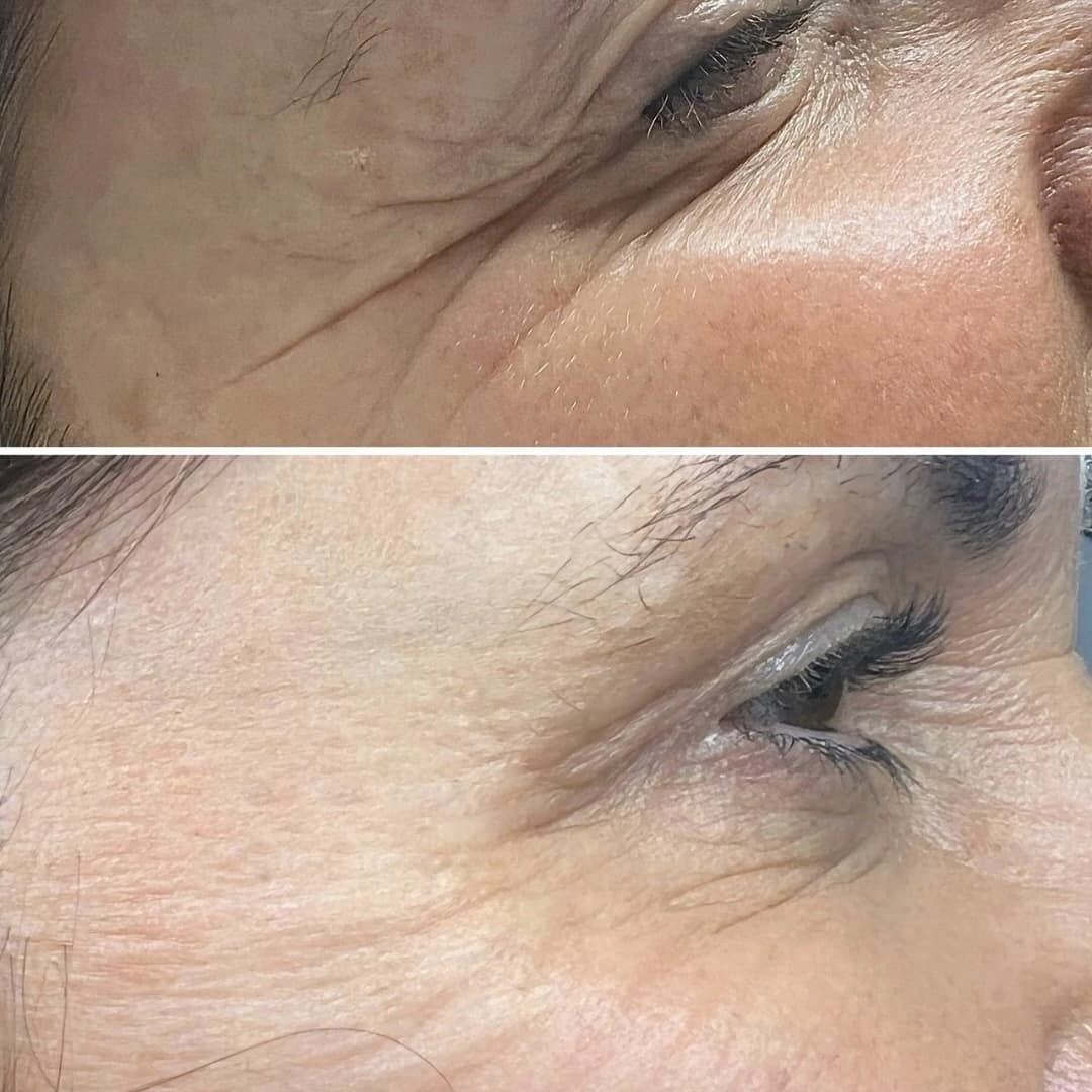 Anti-wrinkle injection results - forehead lines before and after at Beauty Icon Solihull