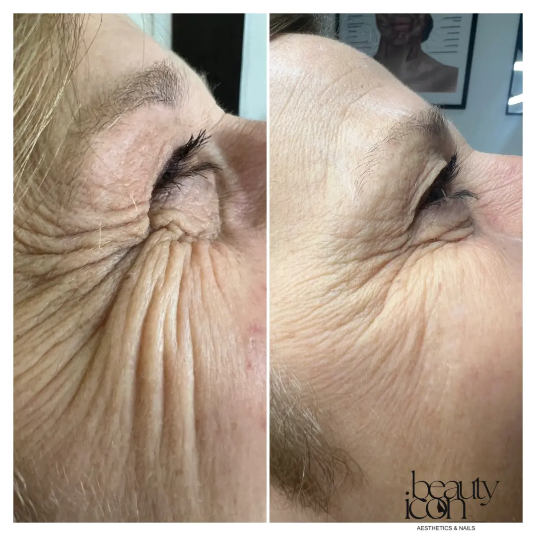 Crow's feet before and after anti-wrinkle treatment at Beauty Icon Solihull